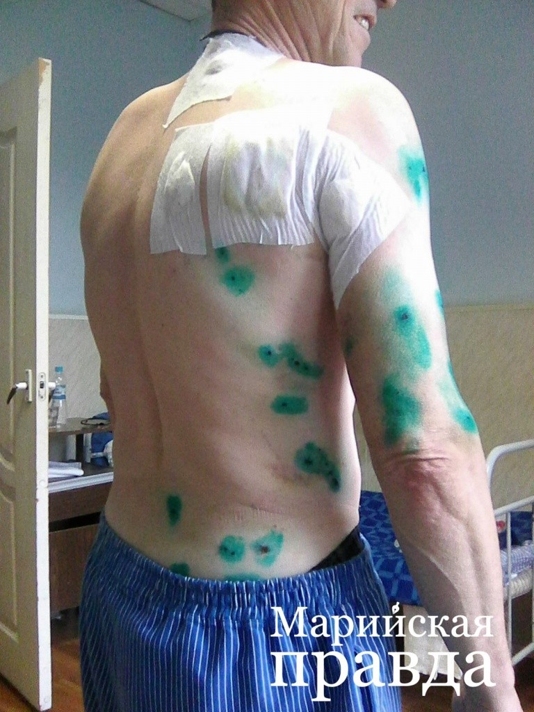 В общей сложности в теле солдата доктора насчитали полсотни осколков.jpg