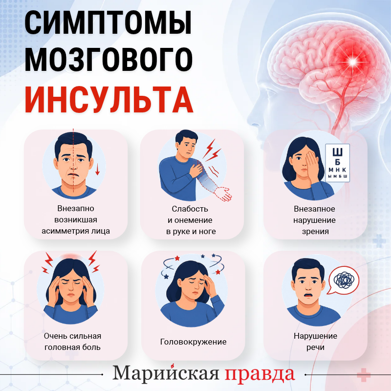 Симптомы мозгового инсульта